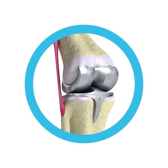 Knee Replacement real image