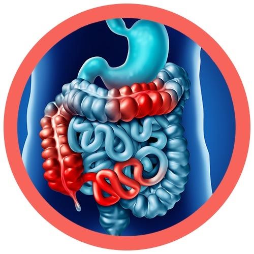 Crohn's real image