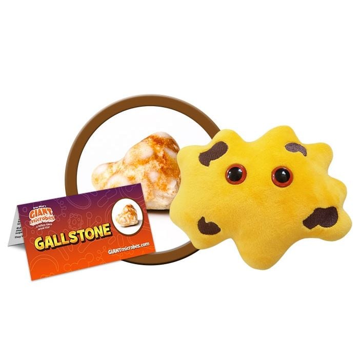 Gallstone cluster